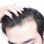 hairfall and dandruff